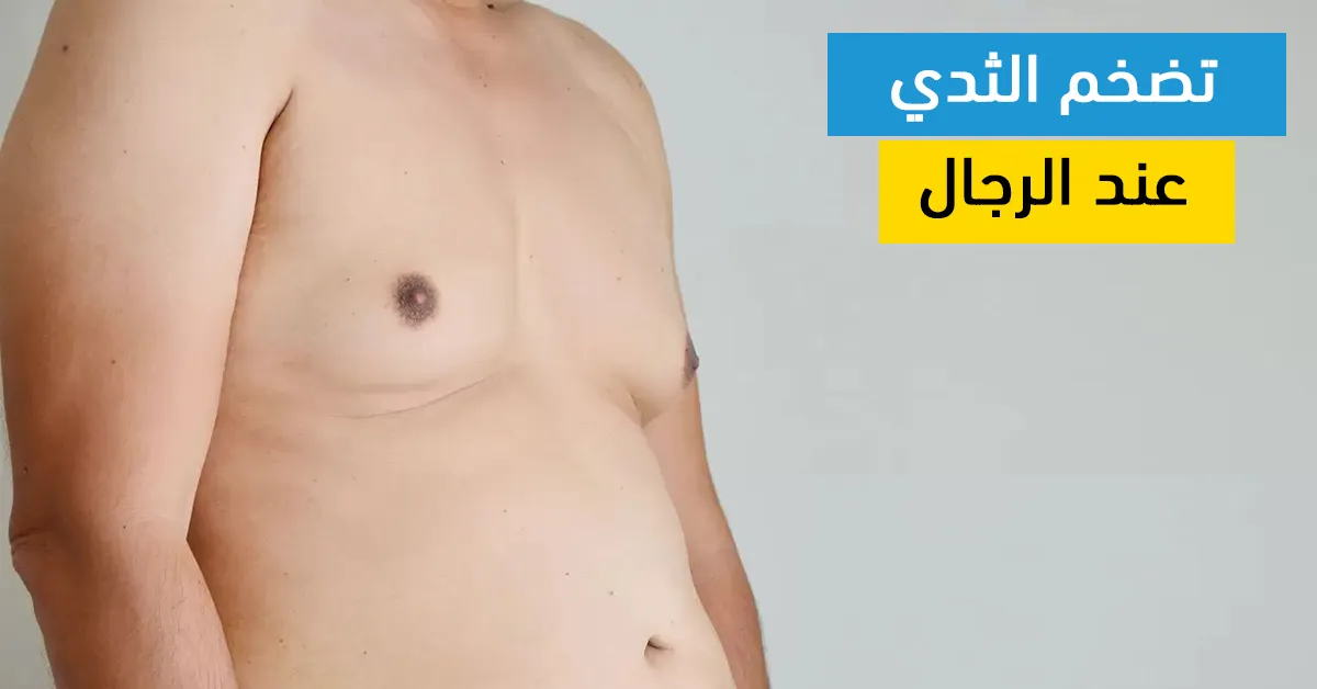 تضخم الثدي عند الرجال